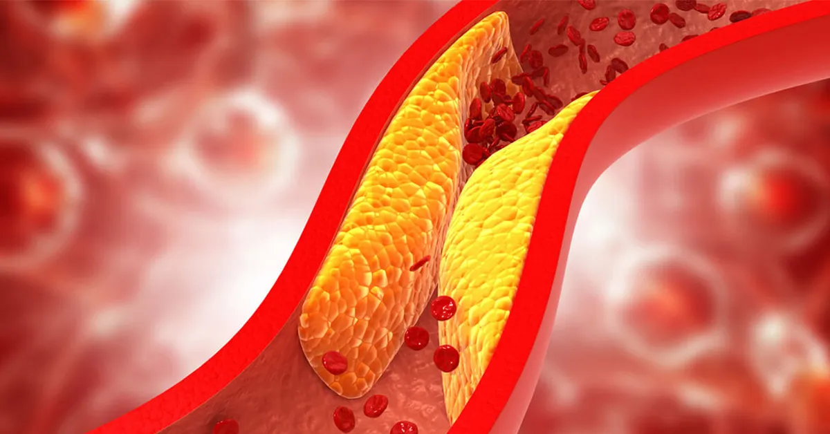Healthy Lifestyle Program:Lower blood lipids